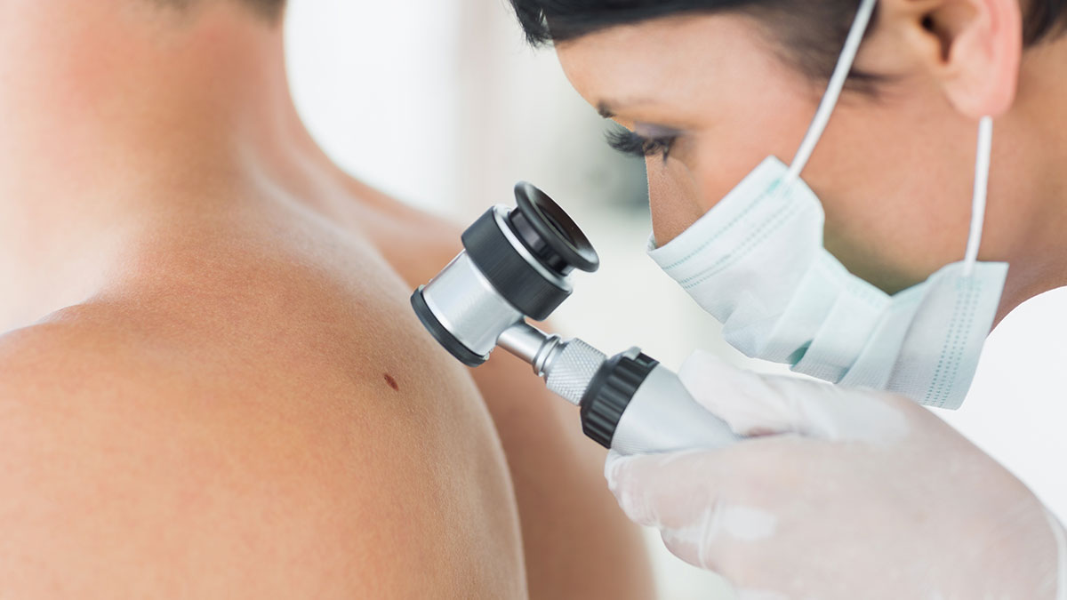 Maggio è il mese per la prevenzione del melanoma - Osserva la tua pelle!